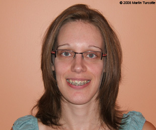 Marie-Hélène Cyr - After orthognathic surgeries (July 26, 2008)